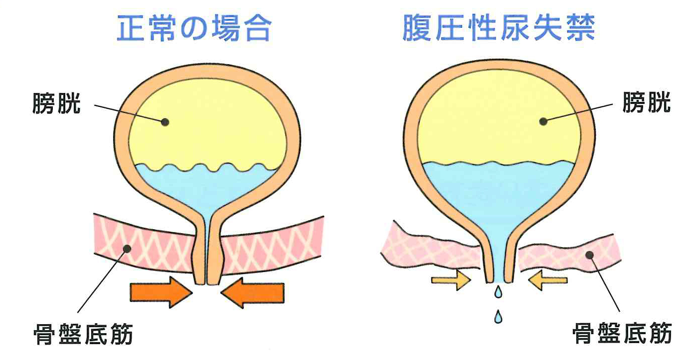 腹圧性尿失禁