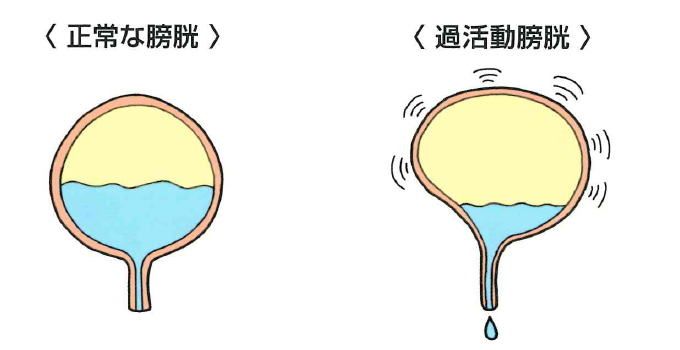 排尿障害（女性）｜吹田市の泌尿器科、内科のももはらクリニック【公式】緑地公園駅徒歩7分