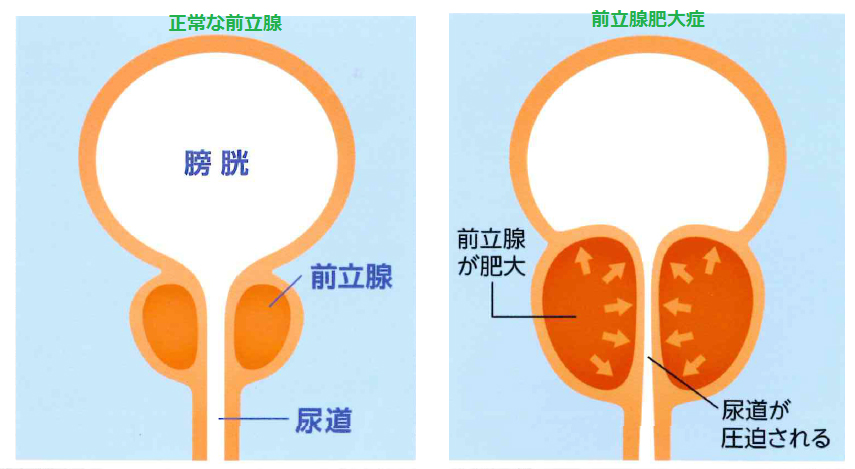 前立腺肥大症